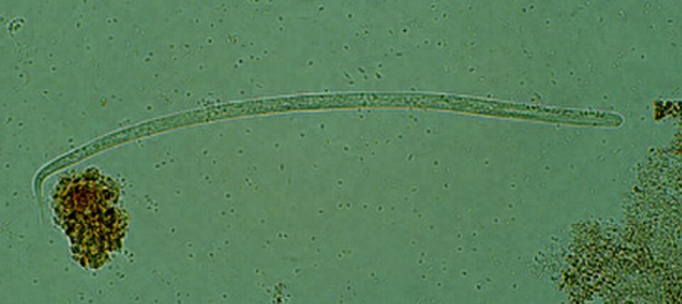 Onchocerciasis