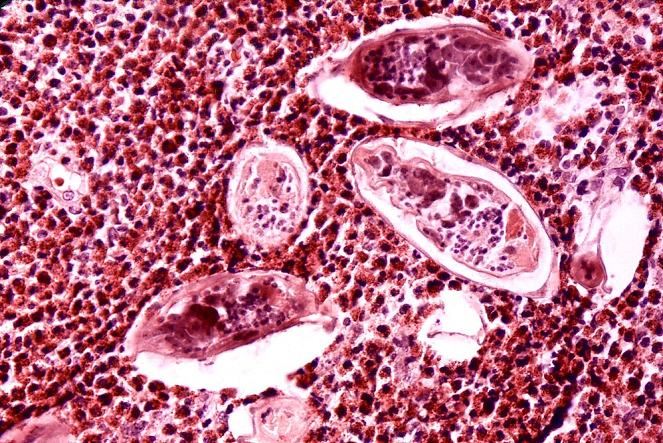 Schistosoma haematobium